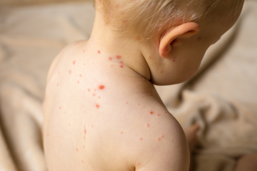 baby-with-chicken-pox.jpg